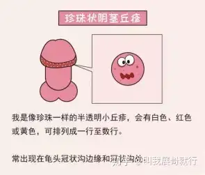 阴茎上边长毛的地方有个疙瘩一按就痛.怎么回事? - 知乎