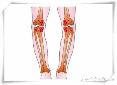 什么是o型腿 - 知乎