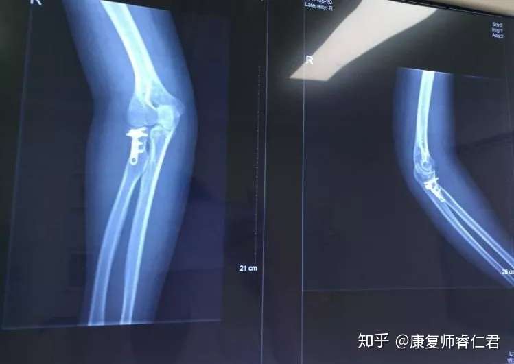 手肘术后僵硬 26岁小姐姐的康复故事 知乎 手肘术后僵硬 26岁小姐姐的康复故事 知乎