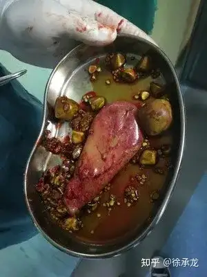 结石在胆囊内形成后,可刺激胆囊黏膜,不仅可引起胆囊的慢性炎症,而且