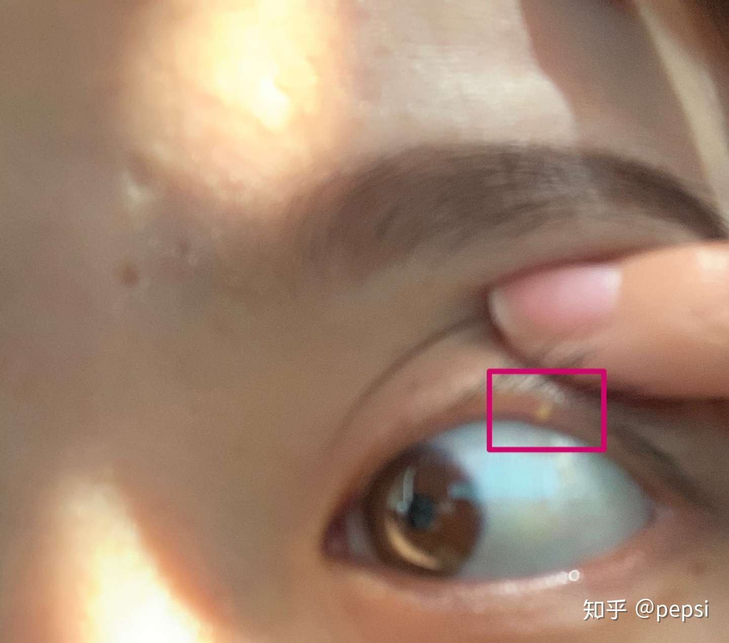 眼皮里长了个东西 是脂肪粒吗 知乎