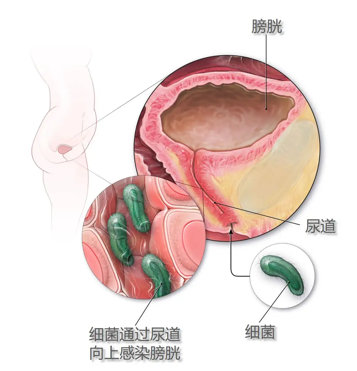 蜜03 尿道易发炎，治疗不丢脸- 知乎