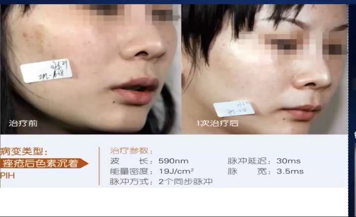 医美的效果强大到真的会上瘾(图4) 医美的效果强大到真的会上瘾(图4)