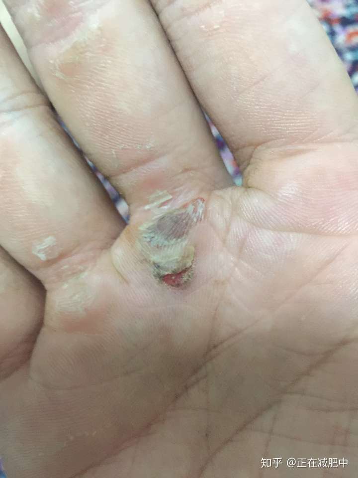 健身手破皮一般怎么处理