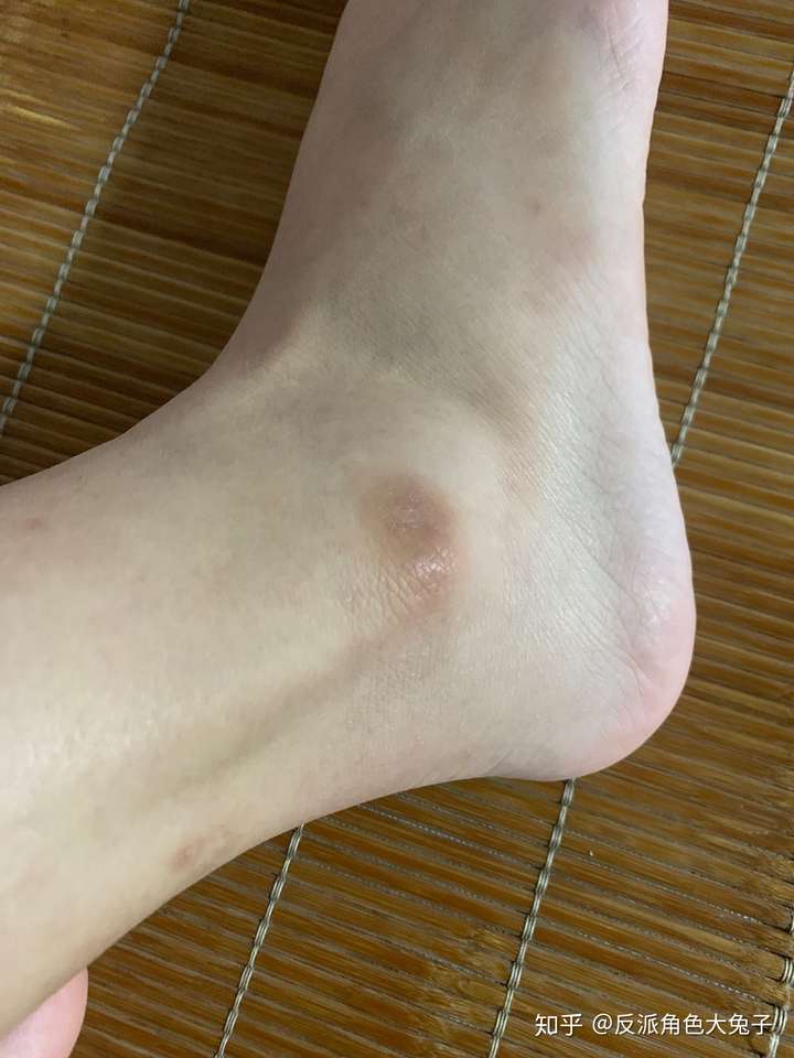 脚踝和膝盖有一些地方没有磕碰自己变黑色色了,什么原因?