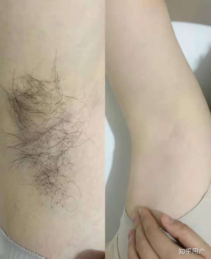 脱毛是用脱毛器还是脱毛膏好呢 知乎 脱毛是用脱毛器还是脱毛膏好呢 知乎
