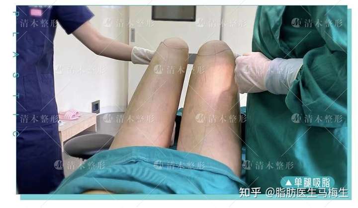 膝盖不好还有什么方法减腿部脂肪?