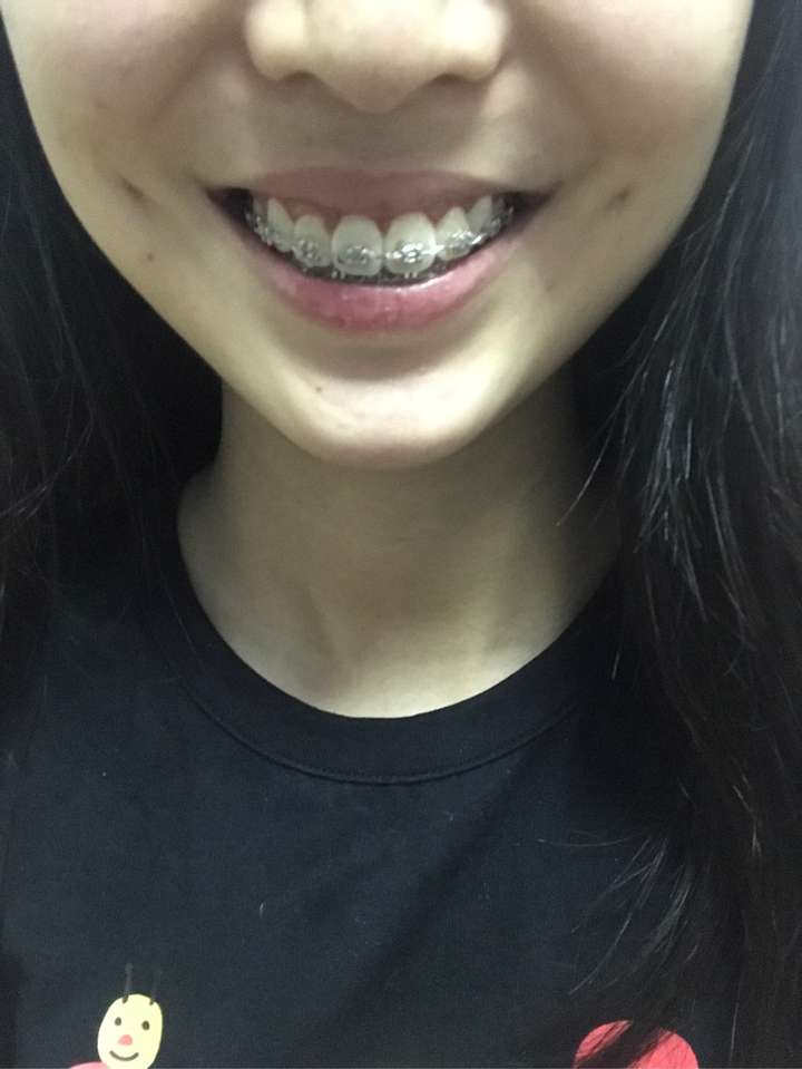 22岁,刚刚摘了牙套,觉得牙齿中线偏移很多,上下牙中线都偏很多,照镜子