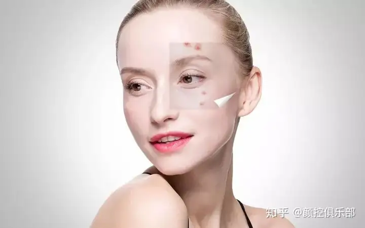 痘坑