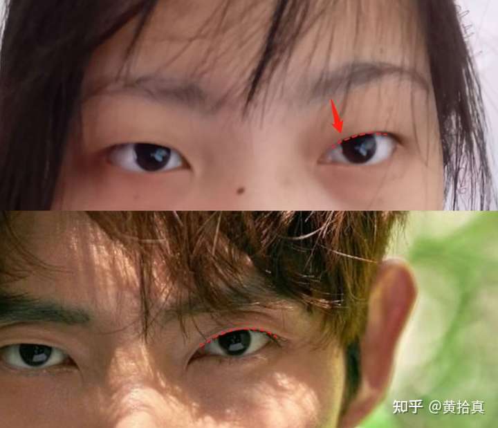 看你是否想改善眼型和形成双眼皮,其次就是你现在的眼睛狭长因为内侧