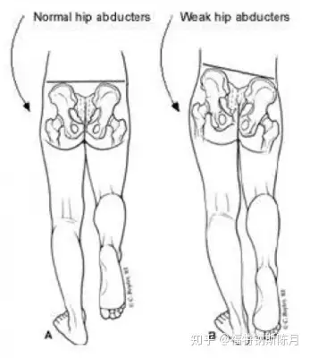特伦德伦堡标志(trendelenburgs sign)是由于疼痛,力量不足导致肌肉