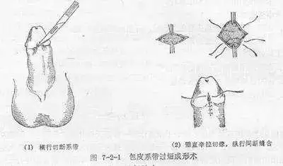 包皮手术后系带短怎么补救? - 知乎