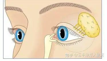 一,泪腺脱垂的鉴别诊断:(1)眶脂肪脱垂:发生在青年人中的真正眶脂肪