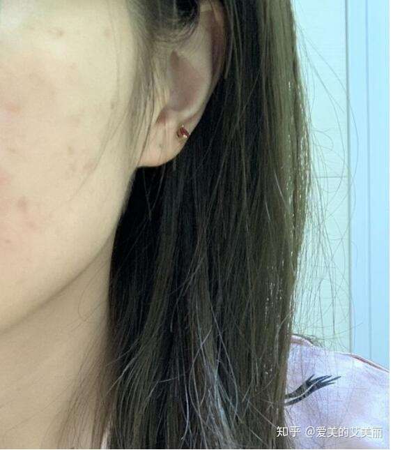 推荐一些祛黑色痘印的药品或者说护肤品?