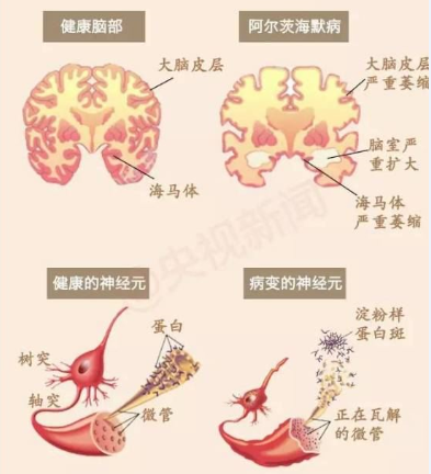 国家卫健委发布阿尔茨海默病诊疗规范要点速看