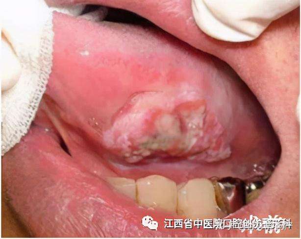 口腔溃疡非小病小心舌癌找上门