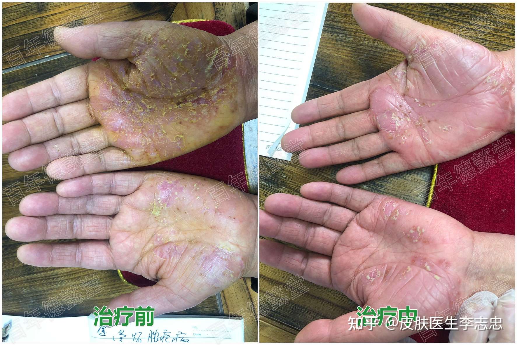 皮肤医生李志忠 的想法: 掌跖脓疱病,经过一个多月的中药内调加泡