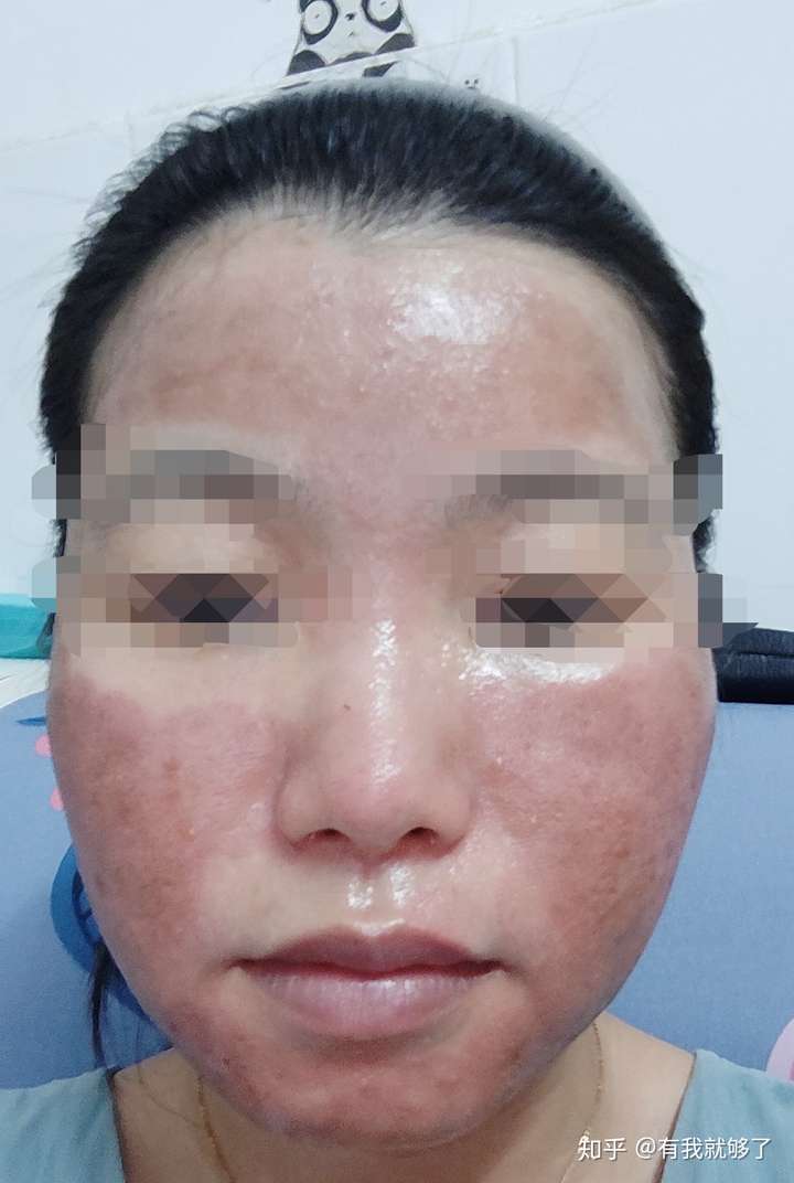 第一次做点阵激光修复痘坑