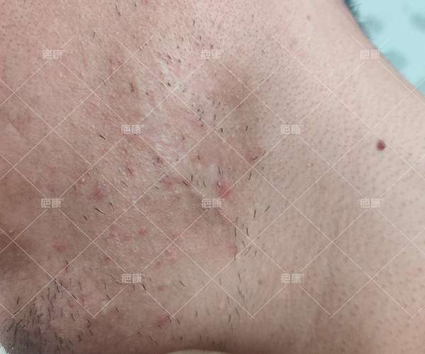 下颌4年瘢痕疙瘩，治疗结束一年后，疤痕颜色接近正常皮肤 