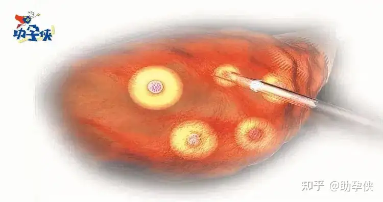 试管婴儿取卵总是空泡怎么办？帮你总结三个方案！ - 知乎