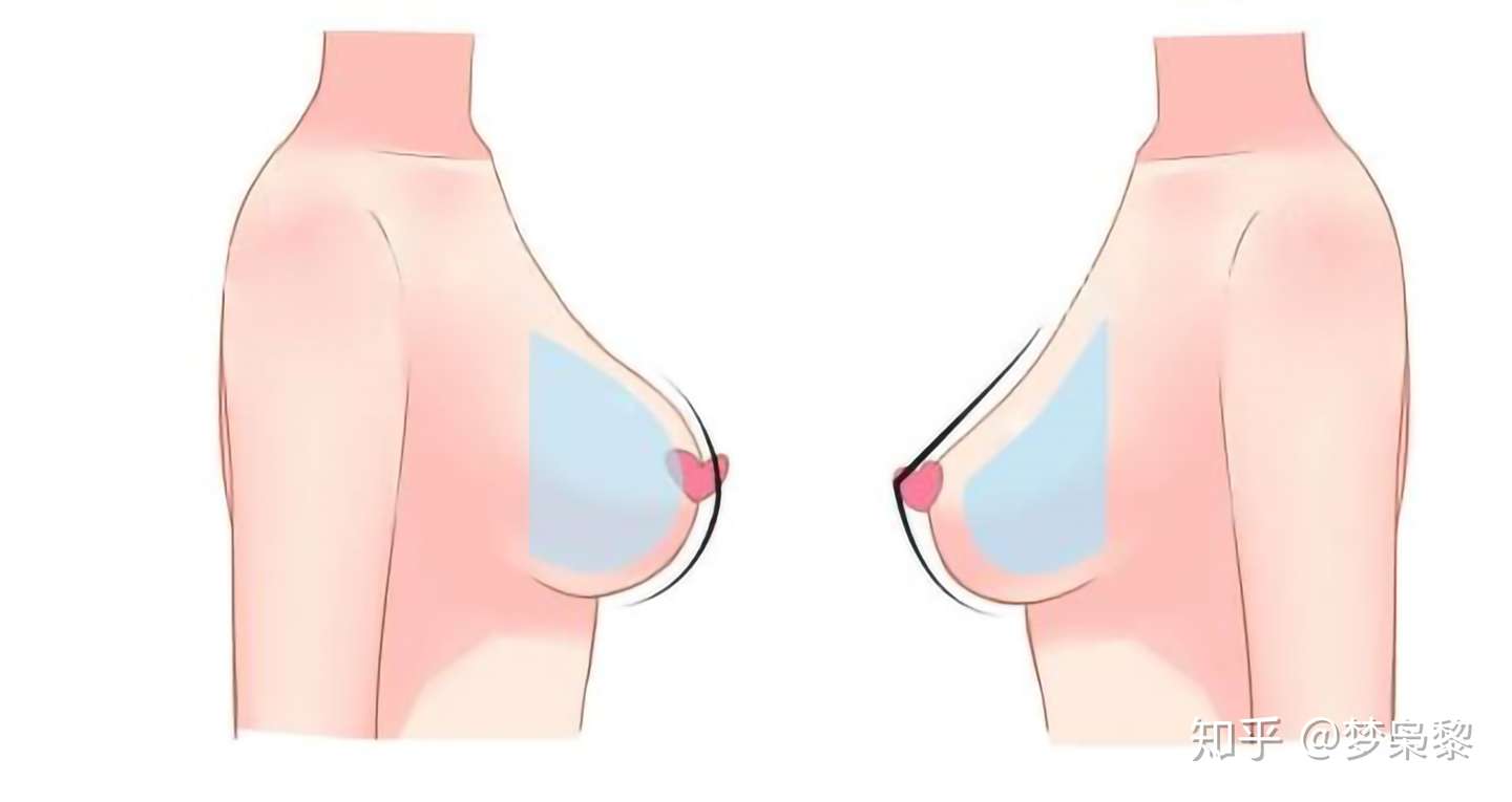 你到底是胸下垂还是胸下移 知乎
