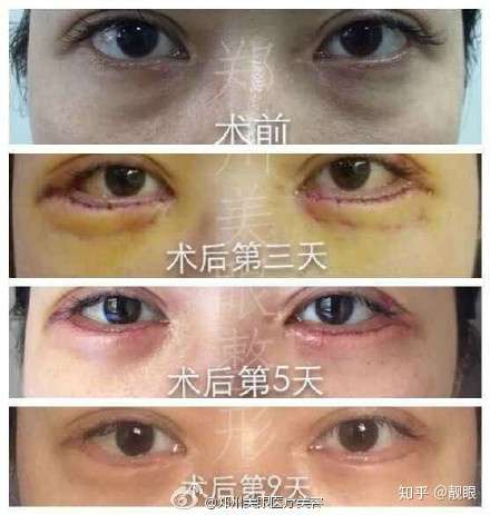 做眼袋手术失败该怎样修复 知乎