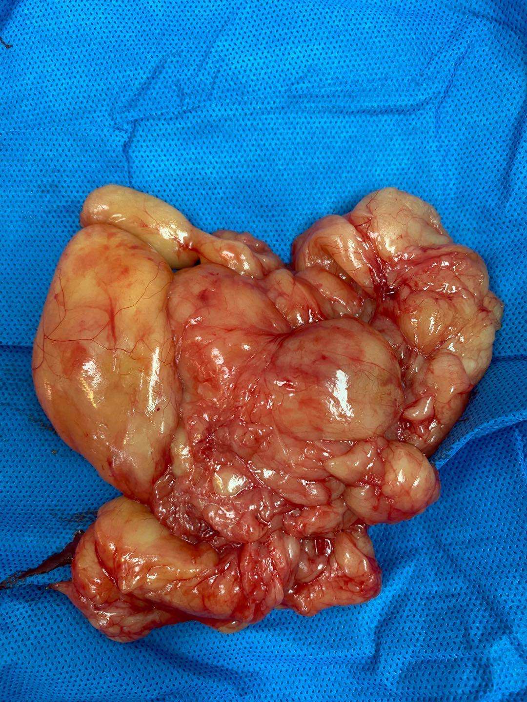 曾博士 的想法: 腋窝的巨大脂肪瘤,长了十多年,切完之后… - 知乎