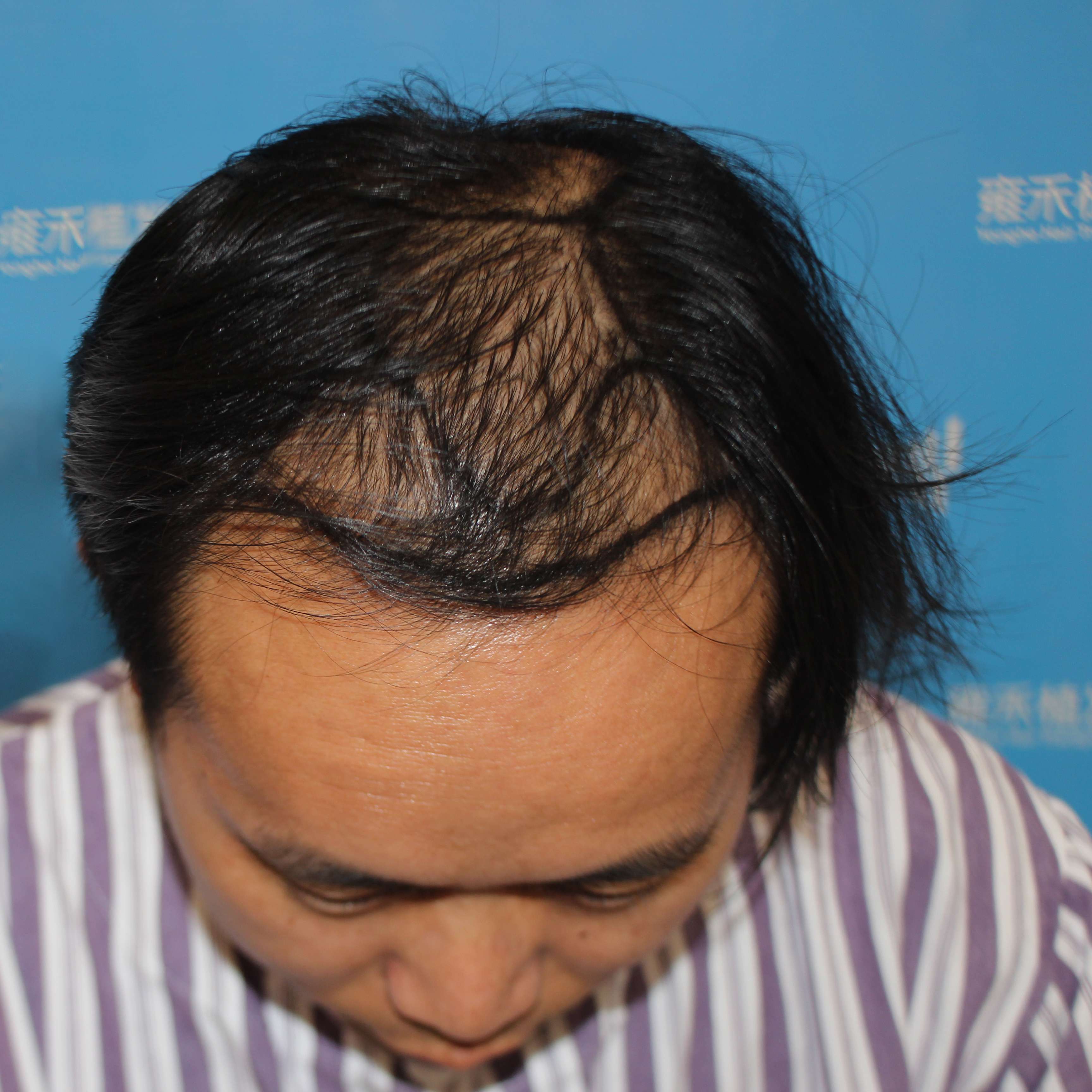 毛发医生徐鲁 的想法: 发际线稀疏,后移就是典型雄激素脱发的特