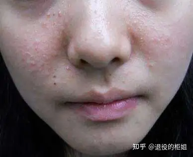 脸颊两侧闭口好几年了 怎么办呢?哭了 ? - 知乎