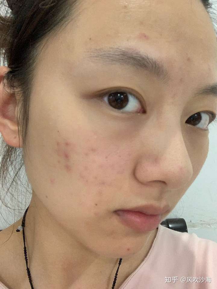 怎么看待五官漂亮但是皮肤差的女性?