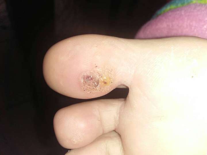 我这个是鸡眼还是跖疣?