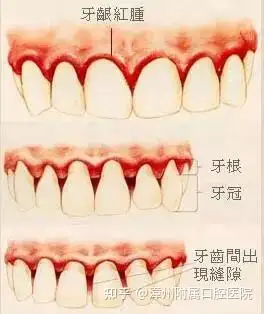 牙周病的五步治疗法