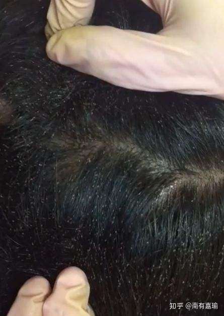 头发上找到的这是什么虫子