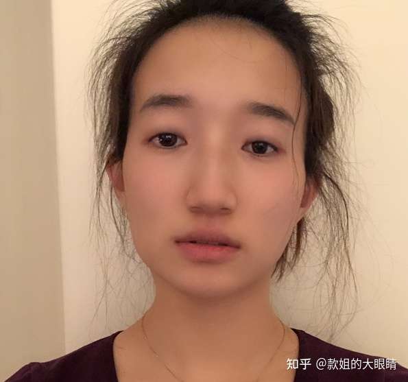 来了来了,案例来了 术前:眼裂短,还存在眼尾下吊,整个眼睛看起来很小