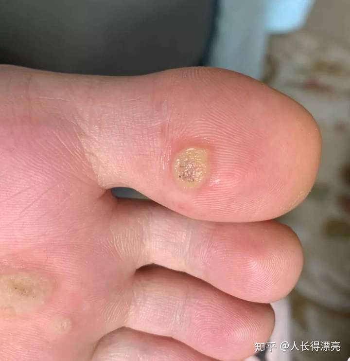注射了九价hpv疫苗后长了丝状疣和扁平疣怎么办