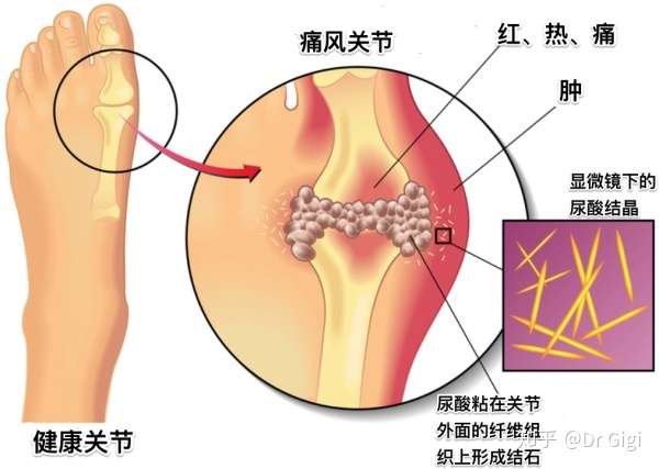 痛风是个什么鬼 知乎