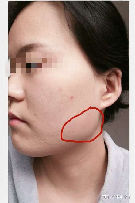 每天吃玉米 咬肌会不会变大?