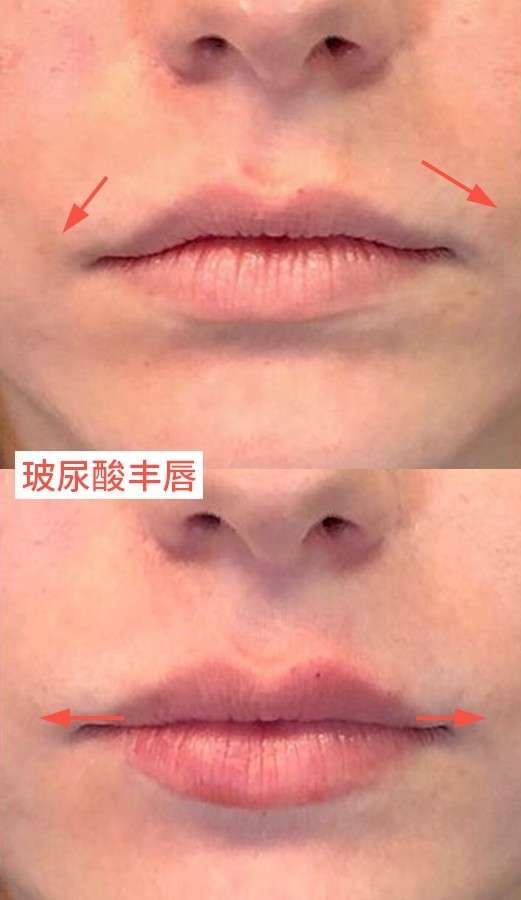 医美避坑系列 千万别学abbily做微笑唇 知乎