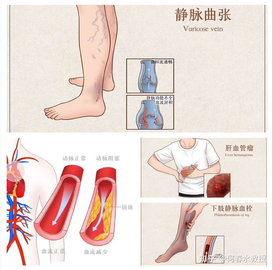 血管疾病患者春季养生3要素 知乎