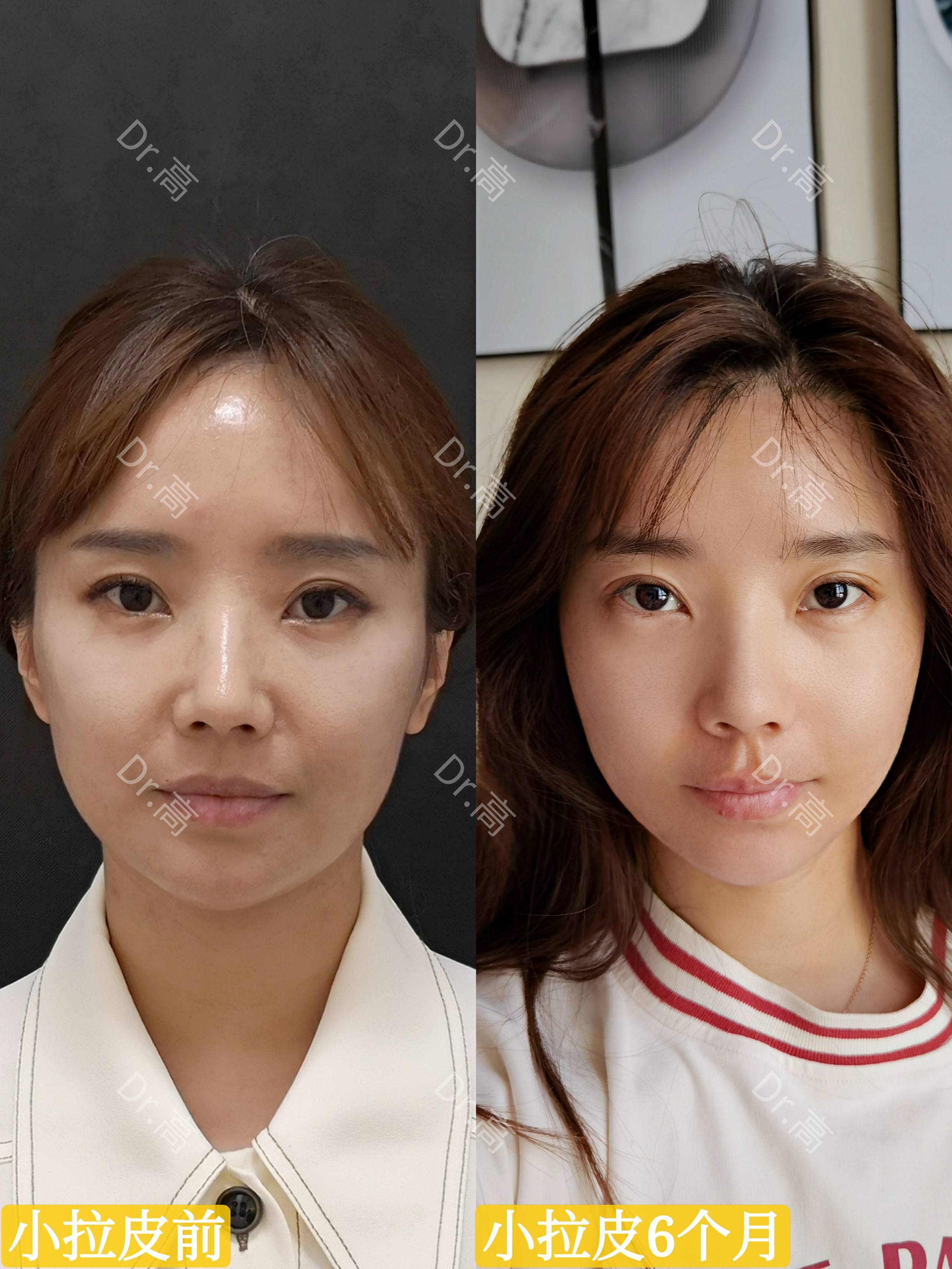 高亚东面部年轻化 的想法 中下面部小拉皮提升6个月法令纹变浅