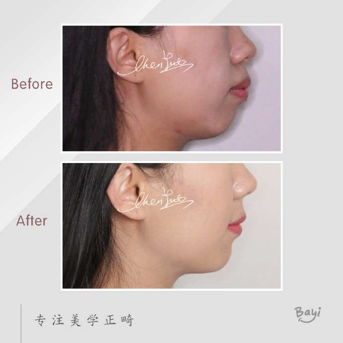 重庆牙齿矫正 牙齿前突案例 知乎