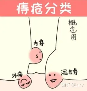 什么是痔疮(简单科普)