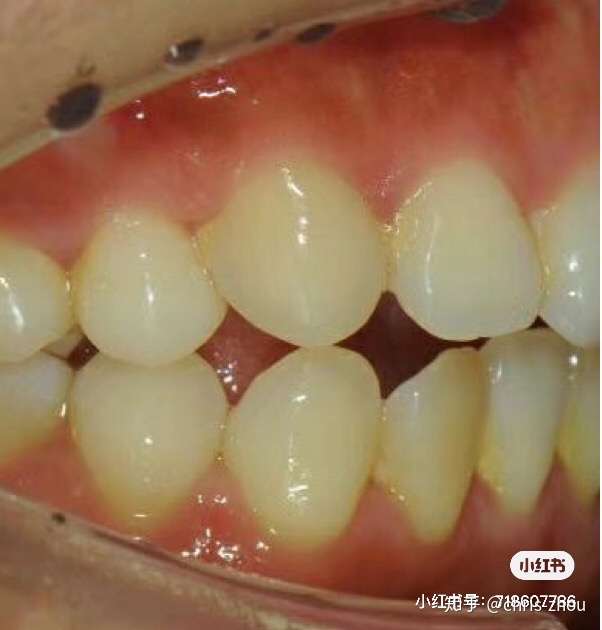 颞下颌关节周茂强 的想法: 类似这样髁突吸收病例,严重高角!