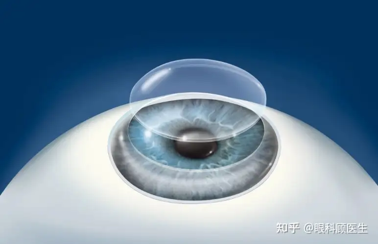 飞秒激光在角膜移植手术中的应用- 知乎