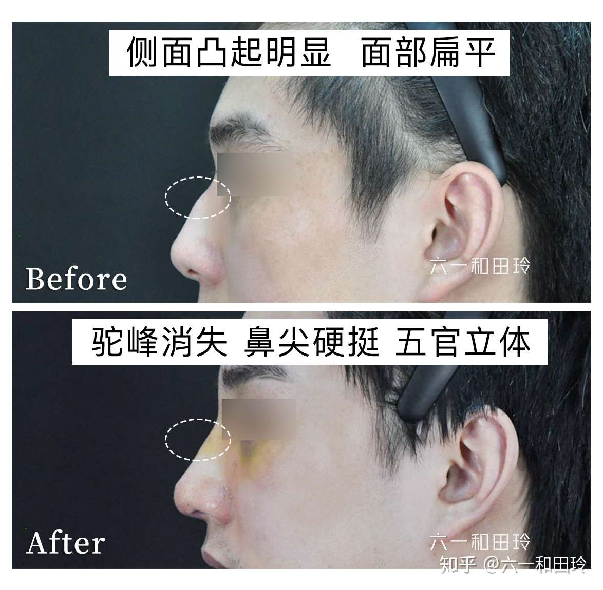 刘亦菲的驼峰鼻好看 我的驼峰鼻就惨了 知乎