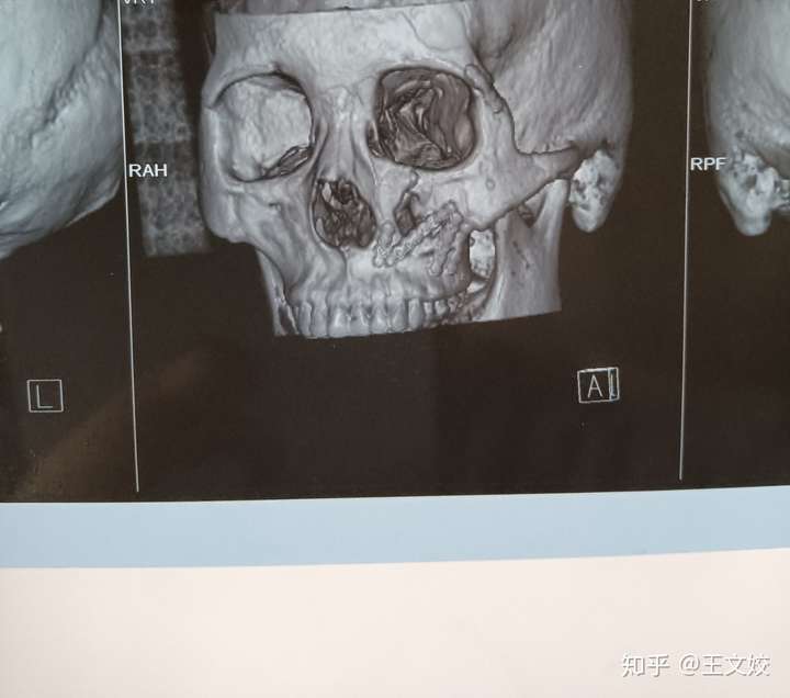 两个月前车祸上颚骨骨折内固定还清了碎骨头二十天前严重感染一星期前