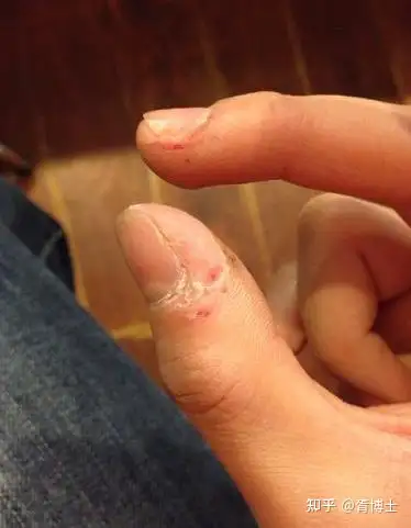 我有时候喜欢扣指甲这是什么情况呢