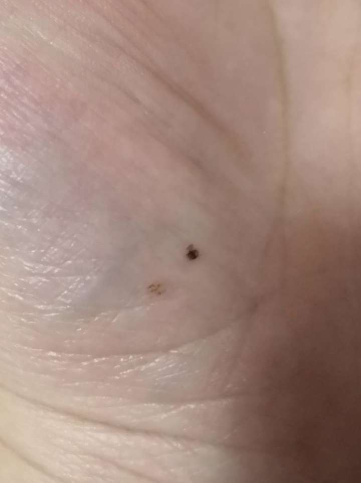 手掌心的痣消失了是怎么回事