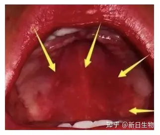 口腔内壁红色血斑图片图片