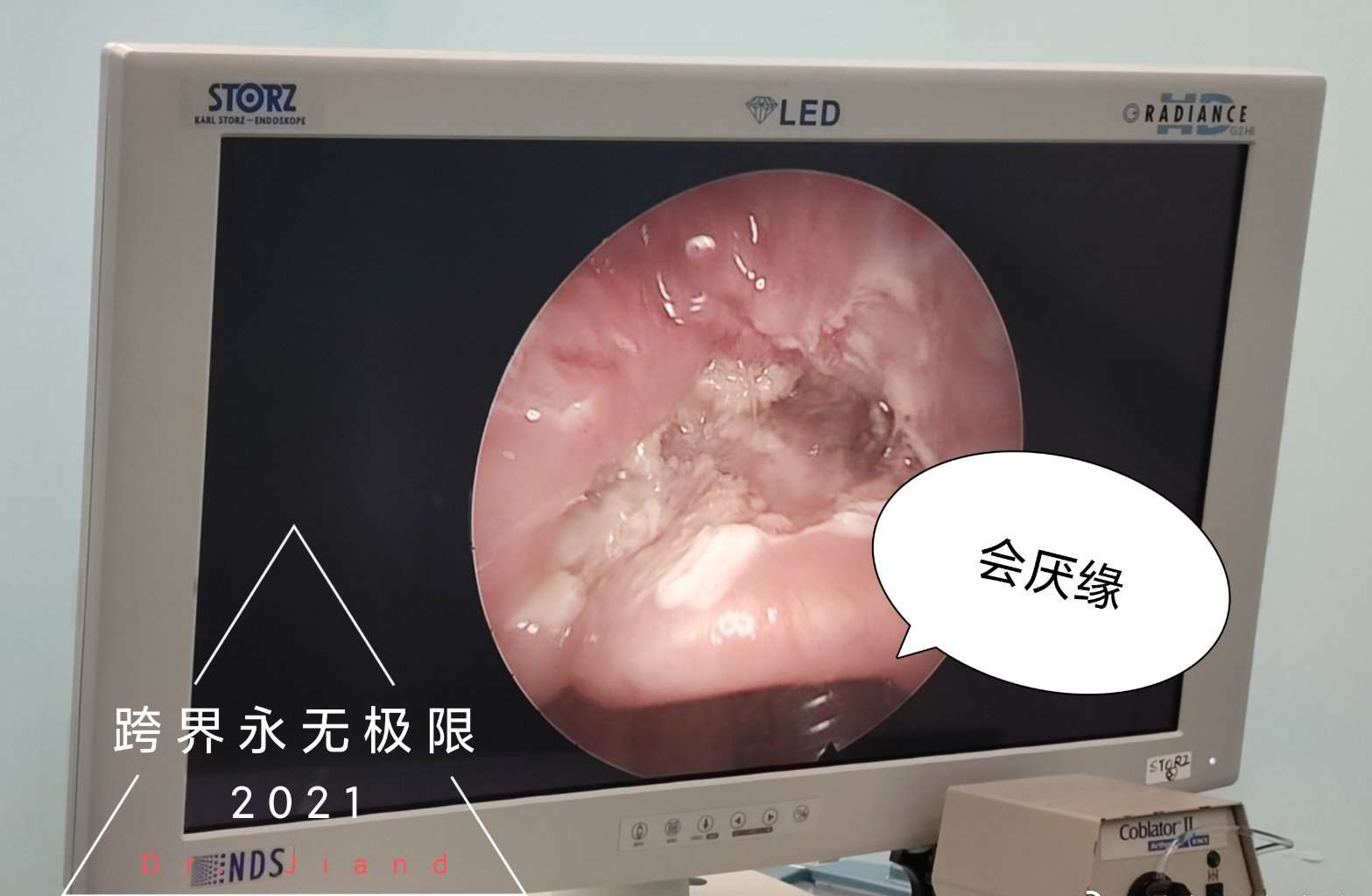 四号手术间,会厌肿物手术结束.会厌最容易出现的病变是囊肿.